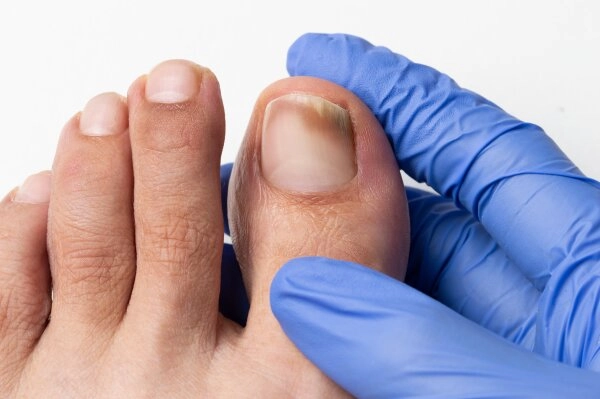 Nagelerkrankungen