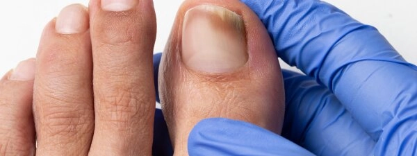 Nagelerkrankungen